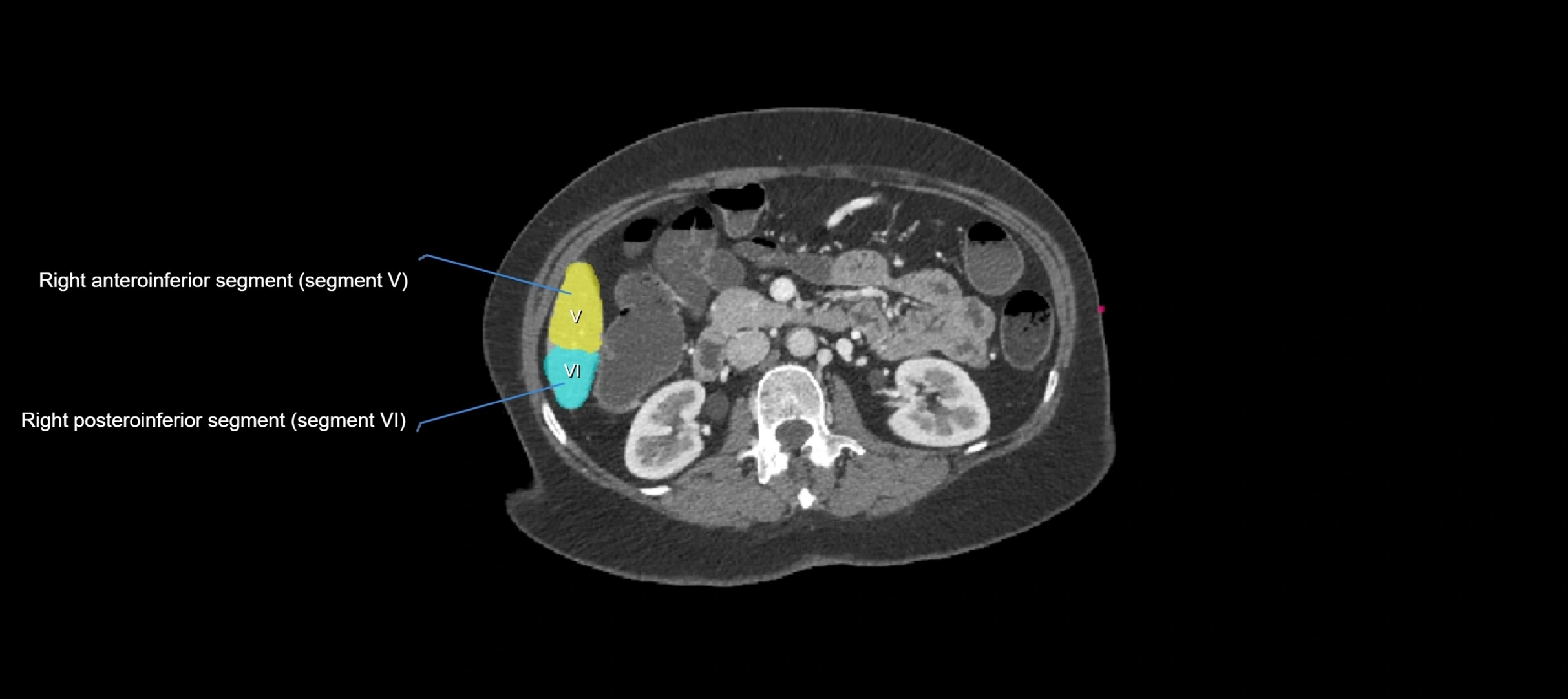 CT liver segments axial cross sectional anatomy labelled image-00015.webp